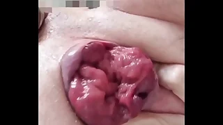 Prolapse play